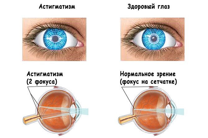 ВОПРОС ДОКТОРУ | ЧТО ТАКОЕ АСТИГМАТИЗМ