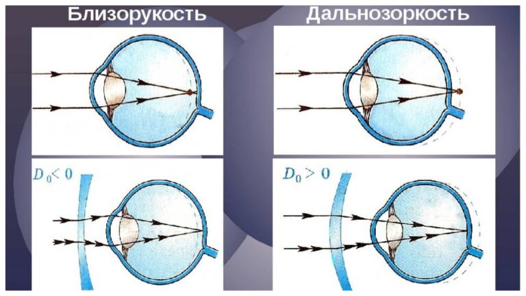 ВОПРОС ДОКТОРУ | КАК ОТИЛИЧИТЬ БЛИЗОРУКОСТЬ И ДАЛЬНОЗОРКОСТЬ